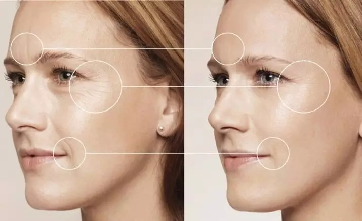 BiRevitalização (80 fotos): o que é efecto, un procedemento con ácido hialurónico para a cara, as revisións 16444_9