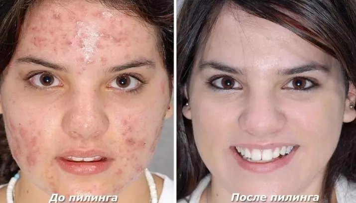 Lasergezicht reinigen (21 foto's): verschil vóór en na de procedure met een laser van acne, wat is het, beoordelingen 16468_11