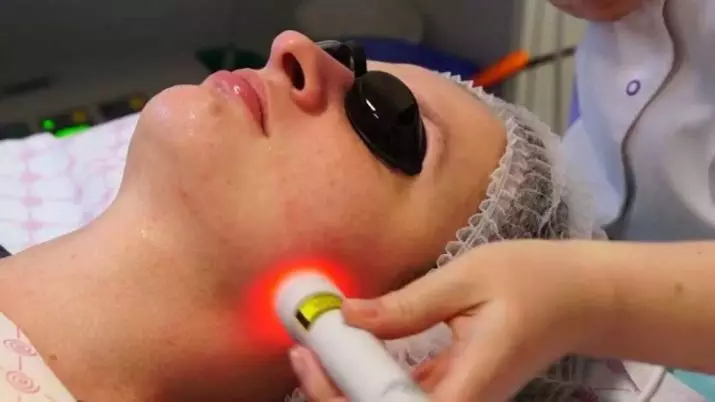 Pulizia del viso laser (21 foto): differenza prima e dopo la procedura con un laser dall'acne, che cos'è, recensioni 16468_12
