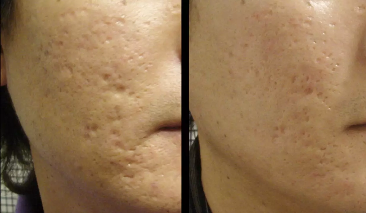 Face au laser Nettoyage (21 photos): différence avant et après la procédure avec un laser d'acné, ce qu'il y a, des critiques 16468_20