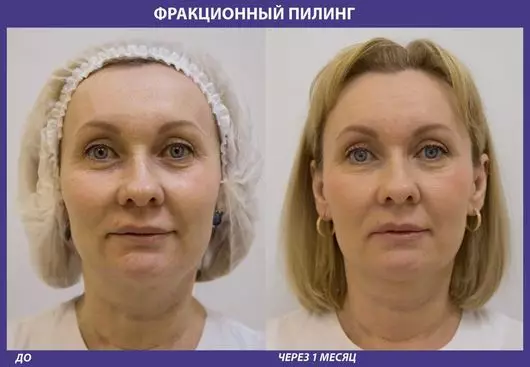 レーザー顔のクリーニング（21枚の写真）：にきびのレーザーと手順の前と後の違い、それが何であるか、レビュー 16468_6