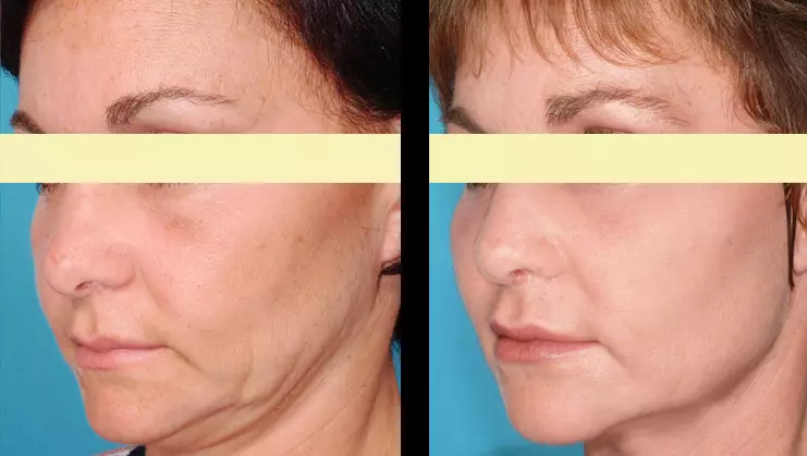 Lasersko čiščenje obraza (21 fotografij): razlika pred in po postopku z laserjem iz akne, kaj je, pregledi 16468_7