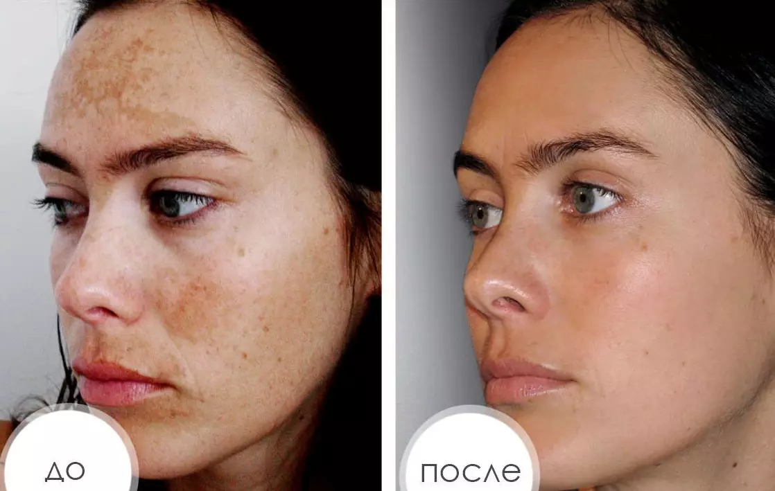 Pulizia del viso laser (21 foto): differenza prima e dopo la procedura con un laser dall'acne, che cos'è, recensioni 16468_9