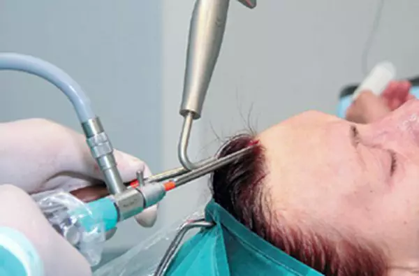 Endoskopska dviganje obraza (24 fotografij): Larma in obrvniki naramnice, operacije za srednje območje, pregledi 16472_2