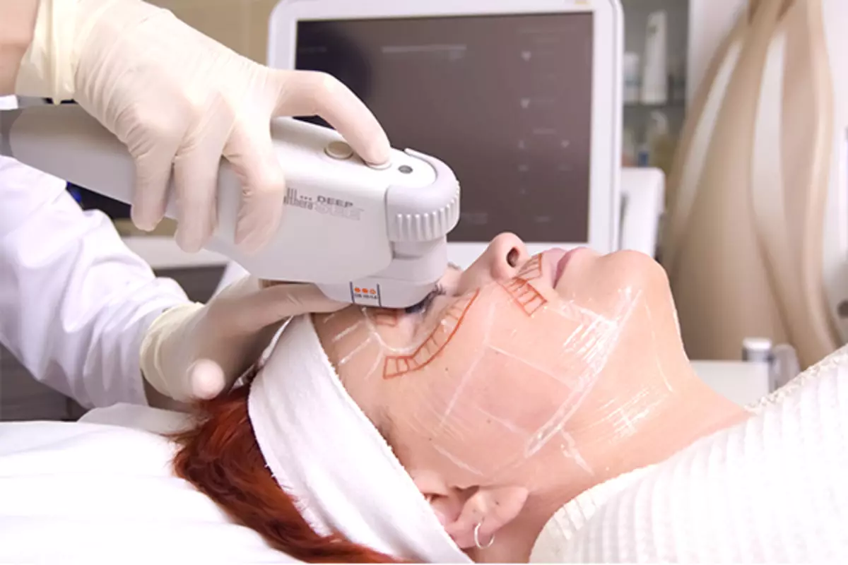 Systém SMAS-Lifting Ulthera System (22 fotek): Ultrazvukový personál pro obličej, recenze kosmetologů lékařů 16479_11