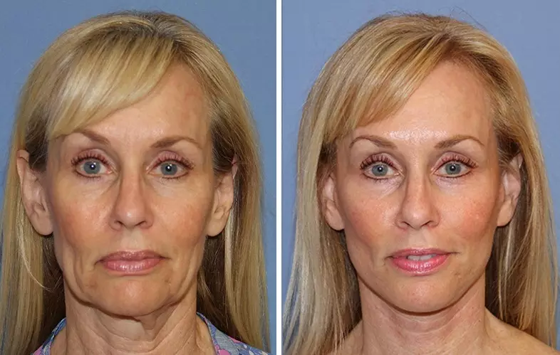 SMAS-LIFTING ULTHERA SYSTEM (22 Bilder): Ultraljudspersonal för ansikte, recensioner av kosmetologer Läkare 16479_14