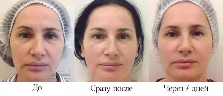 Smas-дигање Ulthera систем (22 слики): ултразвук персонал за лице, прегледи на cosmetologists лекарите 16479_20