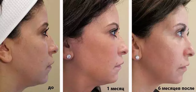 SMAS-LIFTING ULTHERA SYSTEM (22 Bilder): Ultraljudspersonal för ansikte, recensioner av kosmetologer Läkare 16479_21