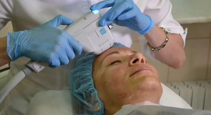 Smas-дигање Ulthera систем (22 слики): ултразвук персонал за лице, прегледи на cosmetologists лекарите 16479_4