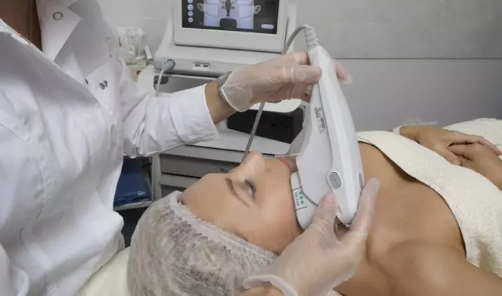 Smas-opheffing Ulthera System (22 foto's): ultraklank personeel vir gesig, resensies van cosmetica dokters 16479_8
