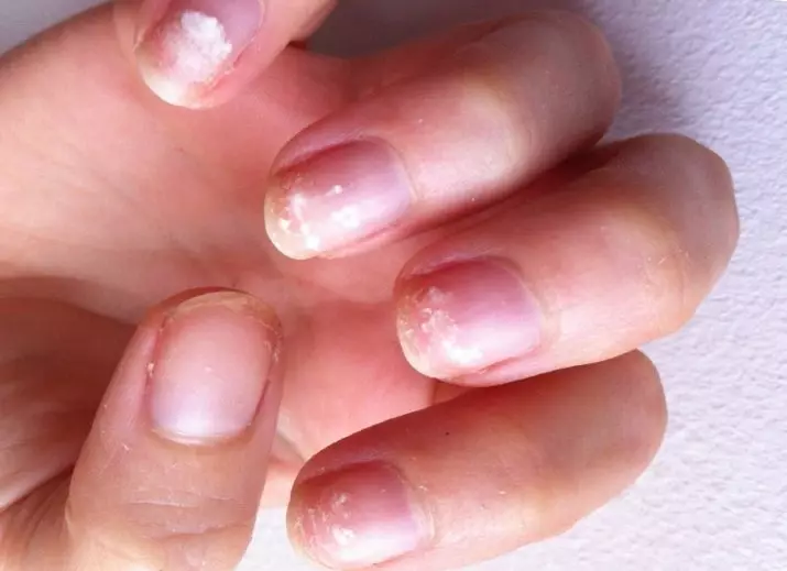 Is Shellac schadelijk voor nagels? 11 foto's schade en gebruik van materiaal. Bedorft hij zijn nagels? Feedback-experts 16992_11