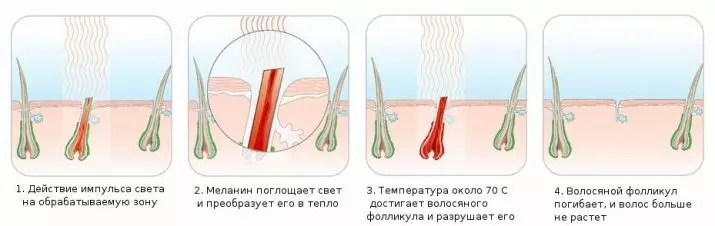 Como se livrar do cabelo no corpo para sempre? Remoção de cabelo indesejado da superfície do corpo? Como remover o excesso de cabelo? 203_16