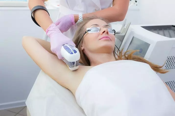 Laser karvanpoisto koko kehon: hiustenpoiston ominaisuudet laserilla, miten valmistautua naisten, vaiheittain 23300_5