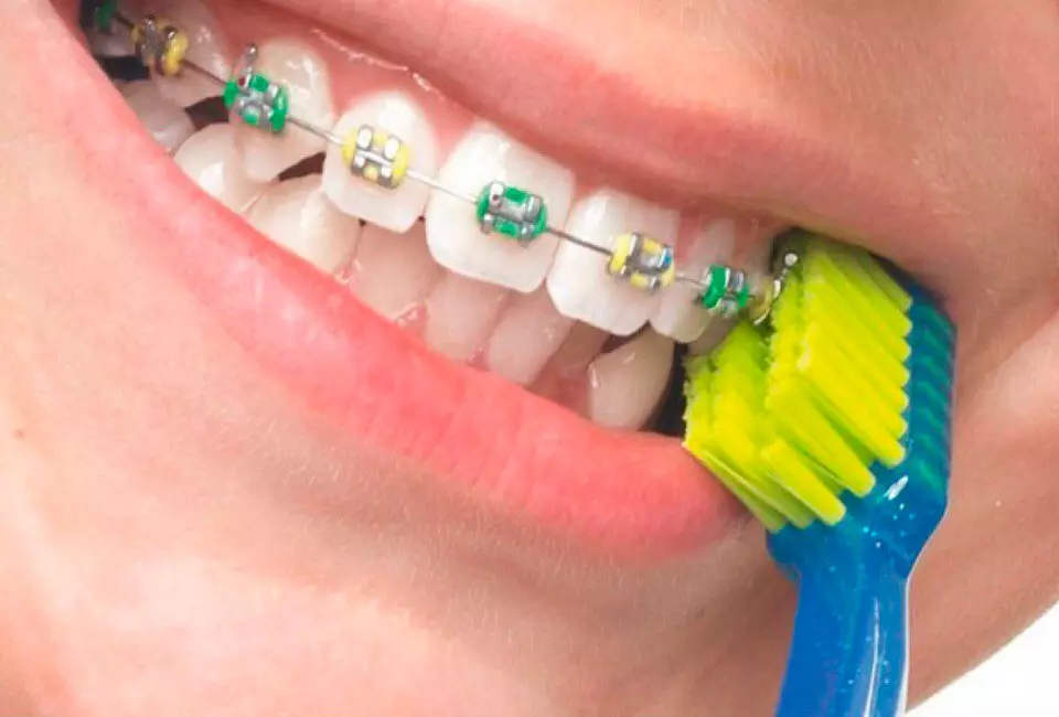 Tandenborstel: de beste borstels voor tanden, bamboe en ionisch, hoe te kiezen, handmatig en wegwerpbaar, andere soorten 24014_25