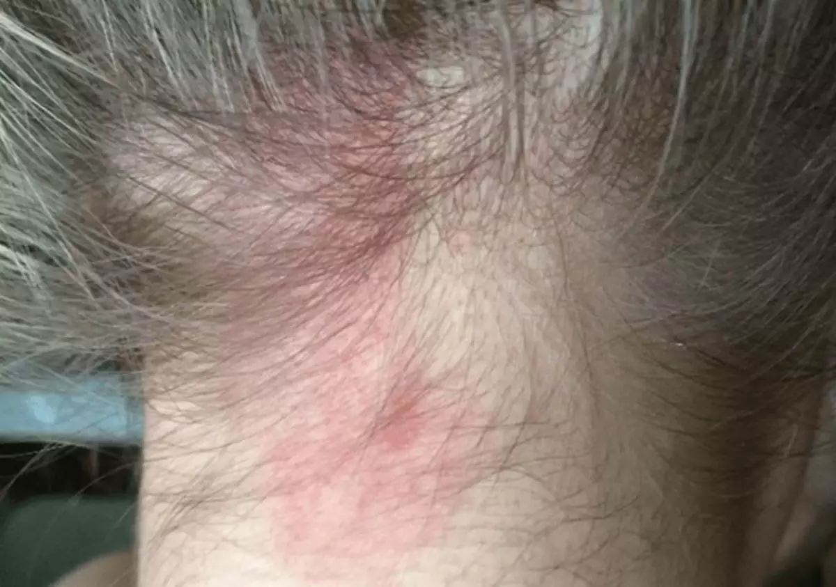 Henna'ya allergiya (14 şəkil): Allergiya üzərində saç üçün saçları necə yoxlamaq olar? Simptomlar və müalicə 24170_3