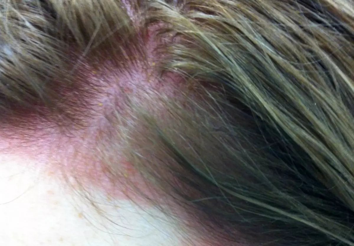 Allergy sa henna (14 mga larawan): Paano upang suriin ang buhok para sa buhok sa alerdyi? Mga sintomas at paggamot 24170_4