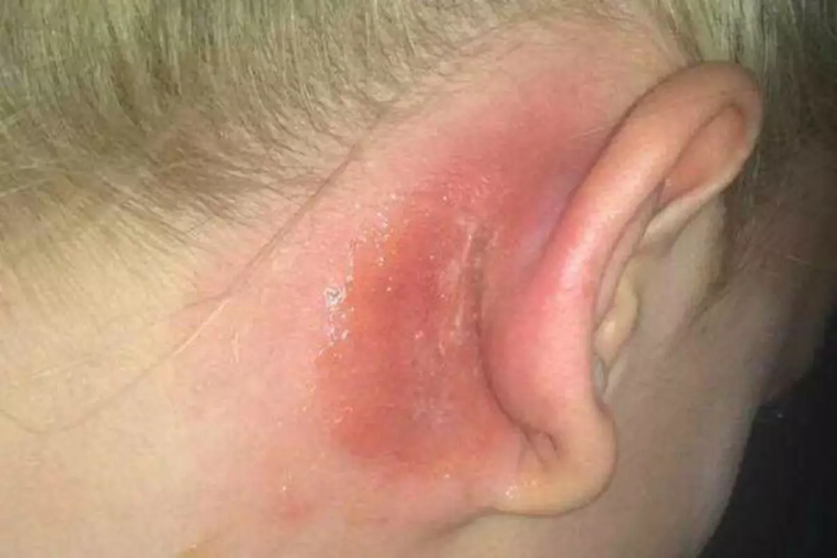 Henna'ya allergiya (14 şəkil): Allergiya üzərində saç üçün saçları necə yoxlamaq olar? Simptomlar və müalicə 24170_5