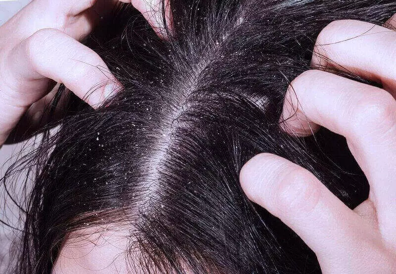 Alergija na Henna (14 fotografij): Kako preveriti lase za lase na alergijah? Simptomi in zdravljenje 24170_8