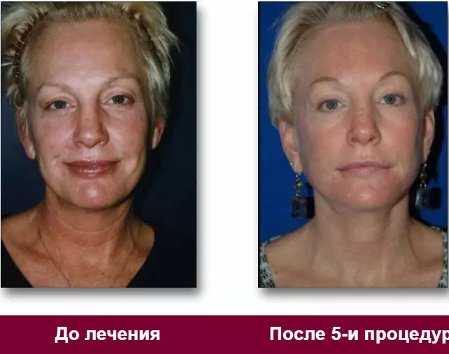 เลเซอร์ Face Rejuvenation (34 รูป): วิธีการฟื้นฟูเศษส่วน 