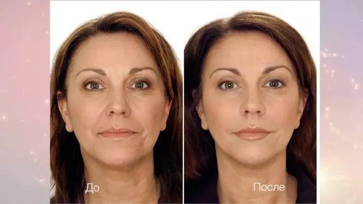 Ringiovanimento del viso laser (34 foto): Metodo di ringiovanimento frazionario 