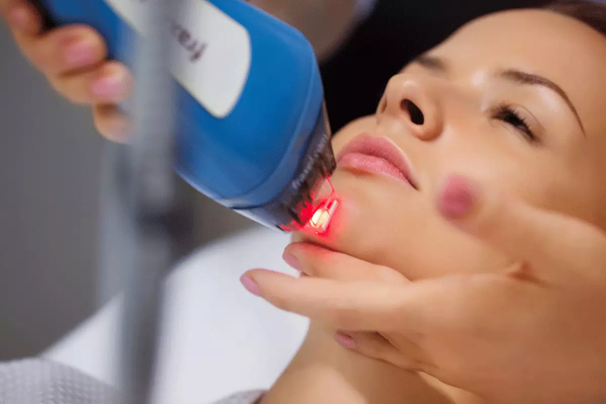 Ringiovanimento del viso laser (34 foto): Metodo di ringiovanimento frazionario 