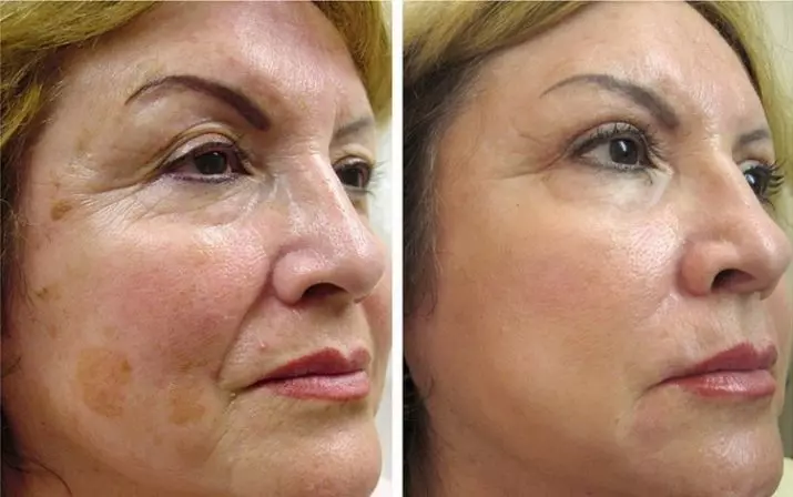 Laser Face Rejuvenation (Picha 34): Njia ya rejuvenation ya sehemu 