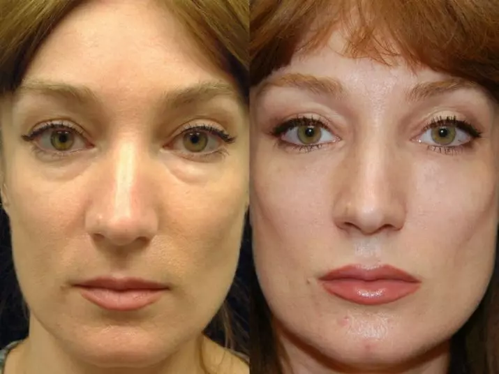 Mesoterapi ansiktsbehandling (65 bilder): Vad det är, ett icke-oförvärv och fraktionellt förfarande, recensioner 4241_19
