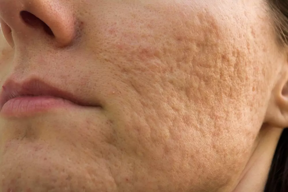 Mesoterapi ansiktsbehandling (65 bilder): Vad det är, ett icke-oförvärv och fraktionellt förfarande, recensioner 4241_28