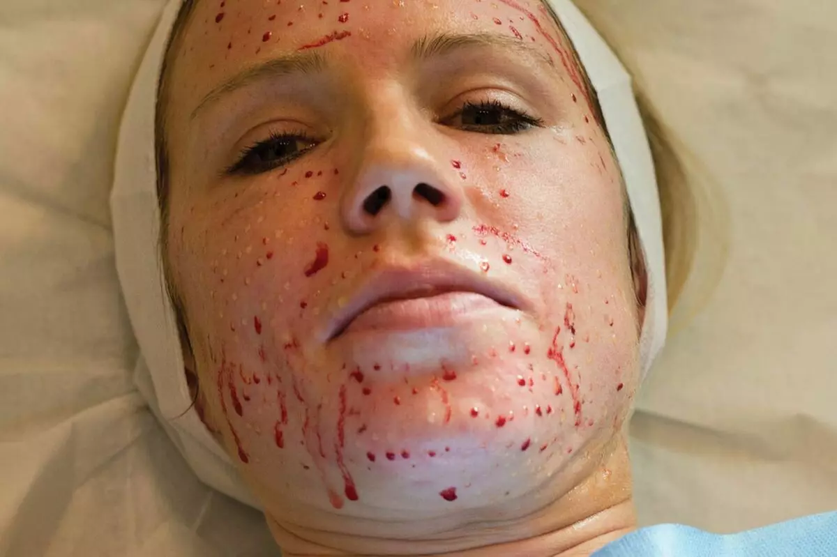 Mesoterapi ansiktsbehandling (65 bilder): Vad det är, ett icke-oförvärv och fraktionellt förfarande, recensioner 4241_31