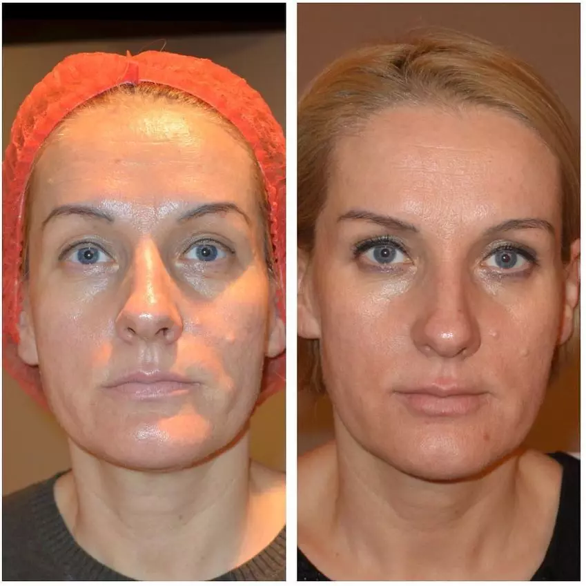 Mesoterapi ansiktsbehandling (65 bilder): Vad det är, ett icke-oförvärv och fraktionellt förfarande, recensioner 4241_34