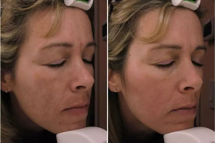 Mesoterapi ansiktsbehandling (65 bilder): Vad det är, ett icke-oförvärv och fraktionellt förfarande, recensioner 4241_5
