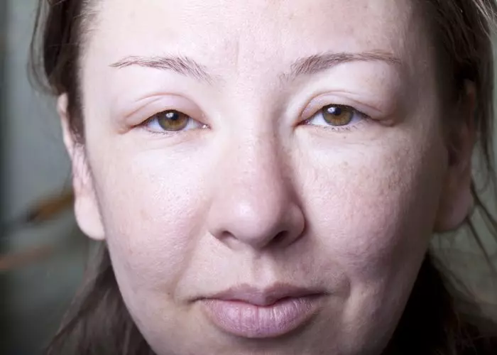 Mesoterapi ansiktsbehandling (65 bilder): Vad det är, ett icke-oförvärv och fraktionellt förfarande, recensioner 4241_57
