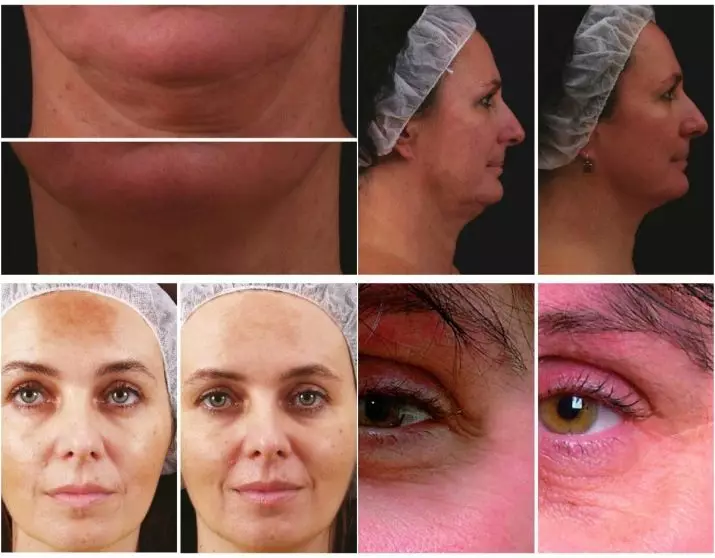 Mesoterapi ansiktsbehandling (65 bilder): Vad det är, ett icke-oförvärv och fraktionellt förfarande, recensioner 4241_59