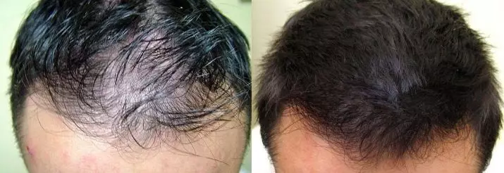Minyak rambut kastor (20 foto): Kaedah untuk memohon minyak Rayan dan Castor untuk pertumbuhan rambut di rumah, ulasan 4845_8