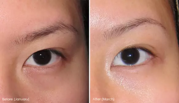 Patches Shiseido: patches kanggo mripat karo muput retinol sing bisa diceret lan ringkesan produk liyane. Ulasan 4994_18