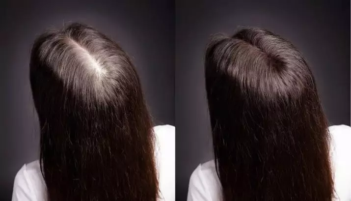 Serum tăng trưởng tóc Alerana: Làm thế nào để làm mất tóc? Hướng dẫn sử dụng và đánh giá của Trichologists 5014_11