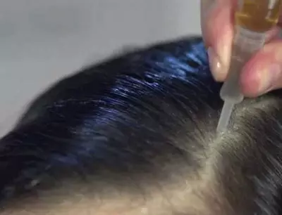 Serum tăng trưởng tóc Alerana: Làm thế nào để làm mất tóc? Hướng dẫn sử dụng và đánh giá của Trichologists 5014_9