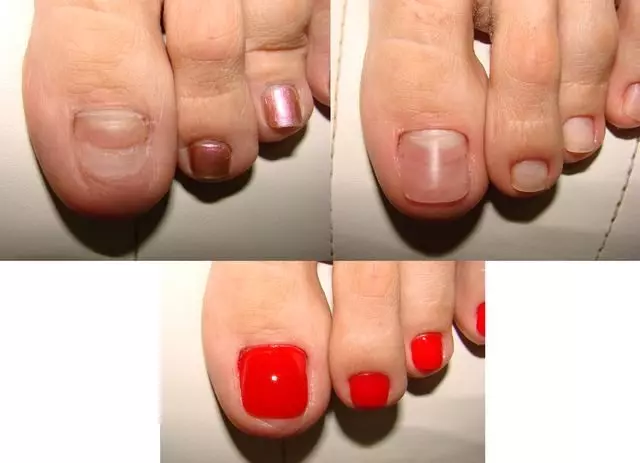 Na noktiju na nogama (43 fotografije): Kako povećati kratke ploče s gelom? Dizajn pedikura na potresanim noktima 6602_12