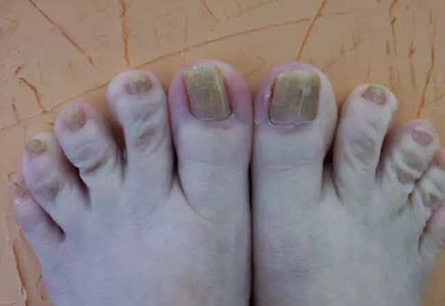 Продолжување на ноктите на нозете (43 фотографии): Како да ги зголемите кратки плочи со гел? Дизајн на педикир на потресените нокти 6602_16