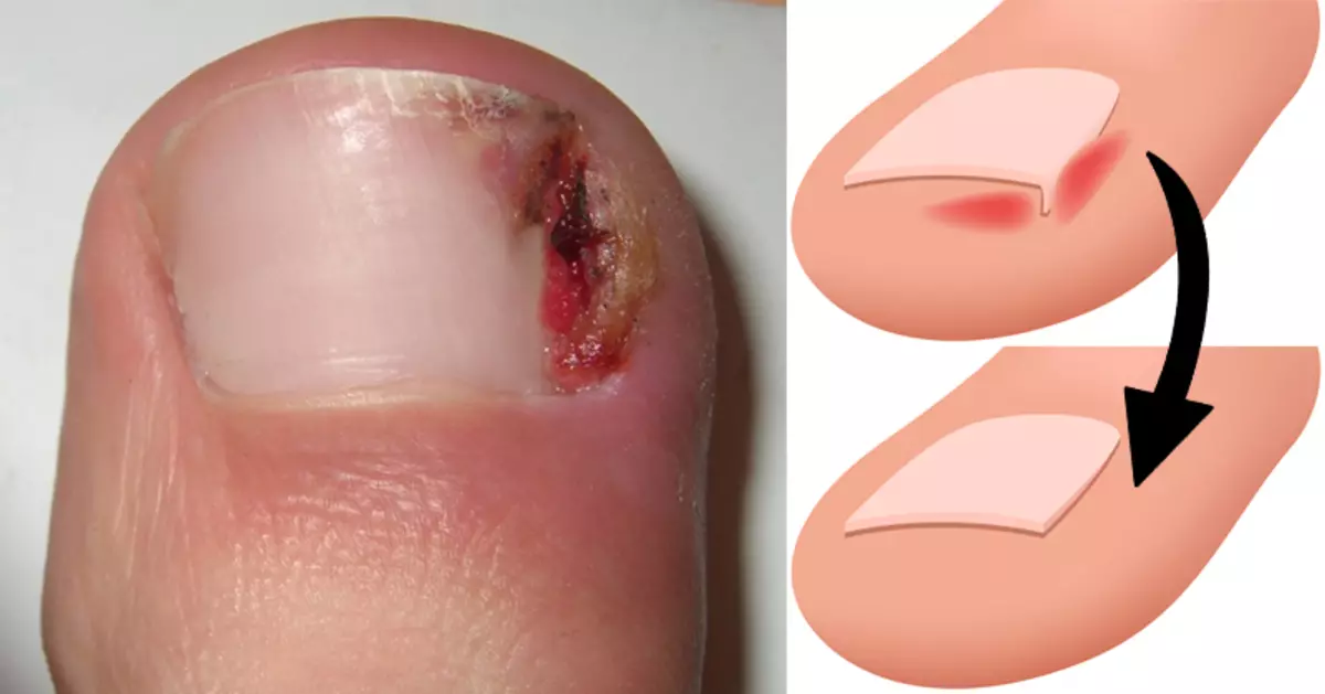 Продолжување на ноктите на нозете (43 фотографии): Како да ги зголемите кратки плочи со гел? Дизајн на педикир на потресените нокти 6602_18