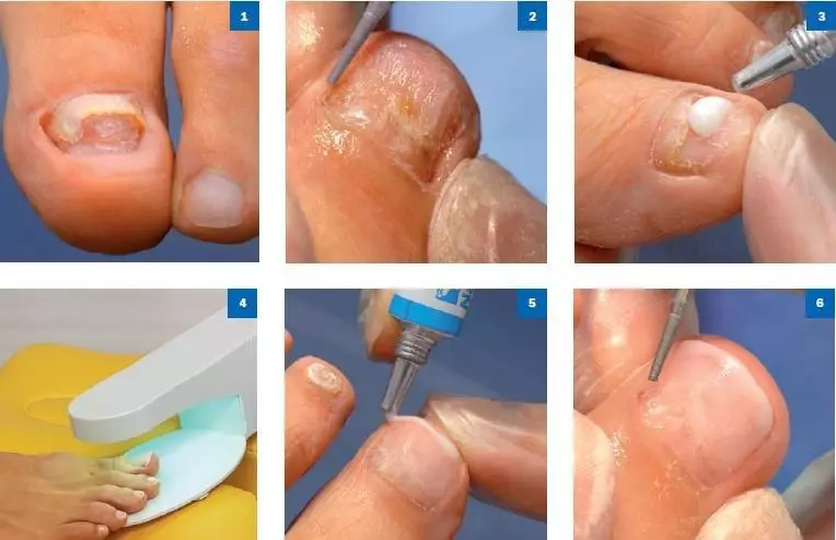 Na noktiju na nogama (43 fotografije): Kako povećati kratke ploče s gelom? Dizajn pedikura na potresanim noktima 6602_20