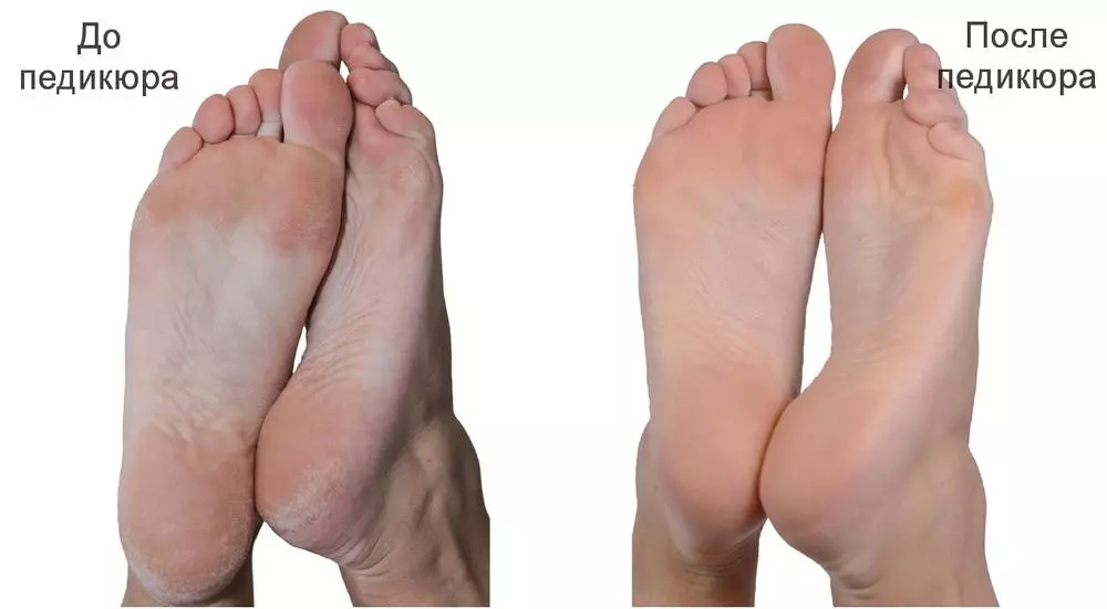 עקב לייזר כרית: בחירת פיזית עם טיפולי ציפורניים על רגליים, ביקורות מוצר Mertz עבור מניקור 6614_14